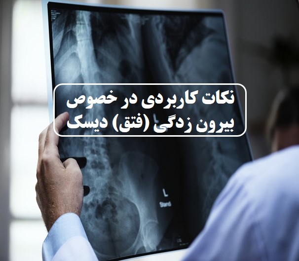 نکات کاربردی در خصوص بیرون زدگی (فتق) دیسک
