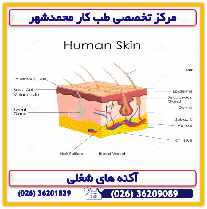 آکنه های شغلی