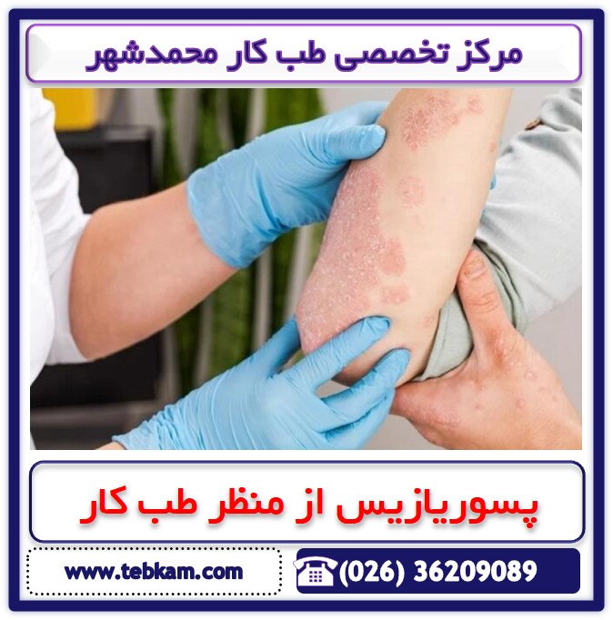 نکاتی در خصوص بیماری پسوریازیس
